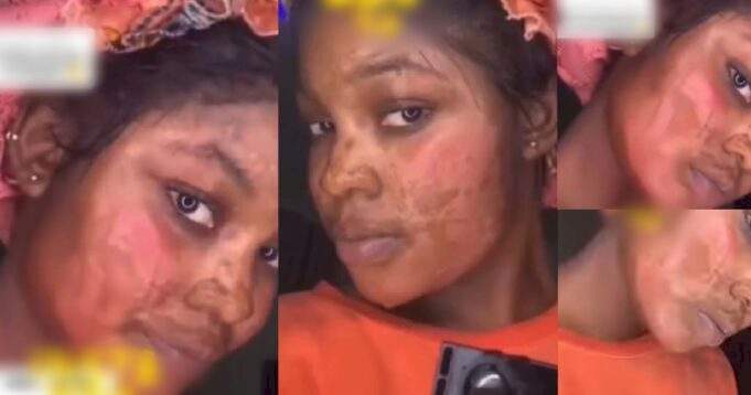 "My bestie bathed me with acid because her man was wooing me" - Lady claims (Video)