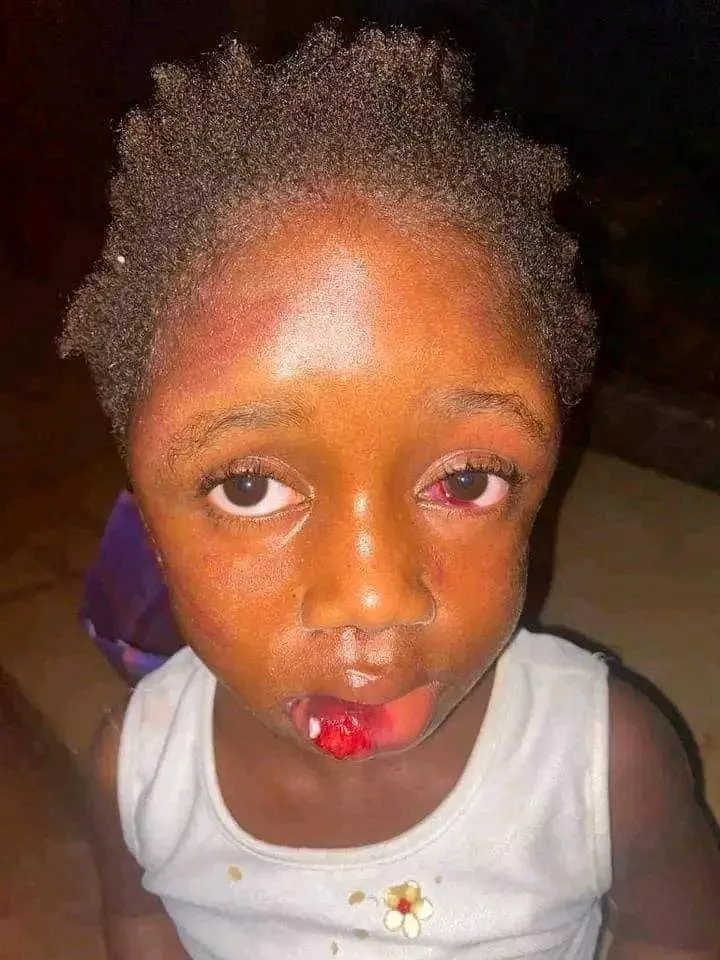 Starving 5-year-old girl mercilessly beaten by her aunt for taking food from pot to eat