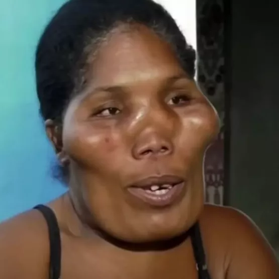Family with mystery illness dubbed aliens after bizarre condition left them with swollen and disfigured faces