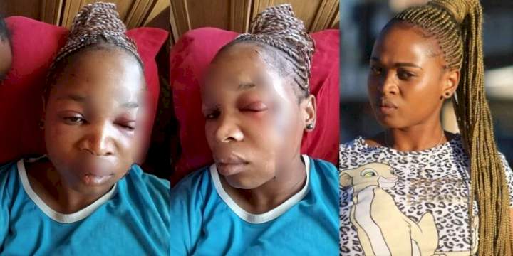 "This is the way I look now" - South African lady shows disfigured face after her baby daddy attacked her with bottle