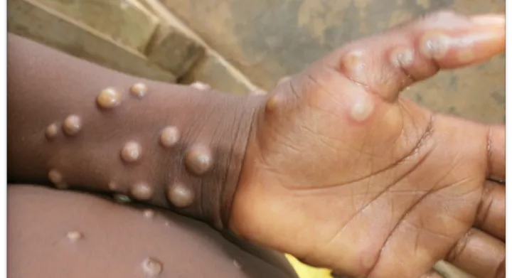 Africa CDC to declare health emergency as Mpox cases surge 160% in 2024