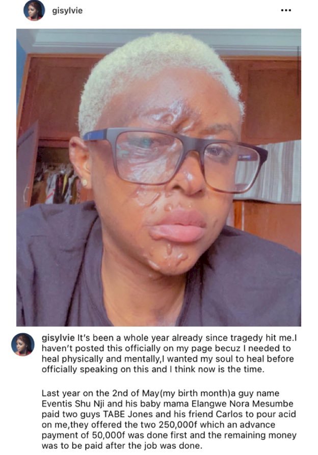 Lady narrates how an envious neighbour paid individuals to pour acid on her