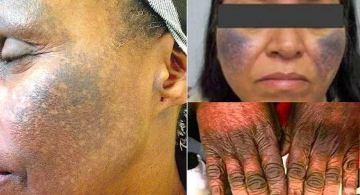 The dangers of using bleaching creams and how to repair the damage