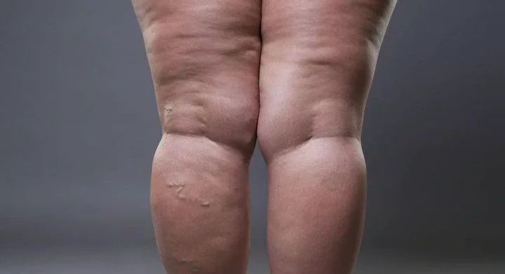 Cellulite: Here's what they are and how to get rid of them