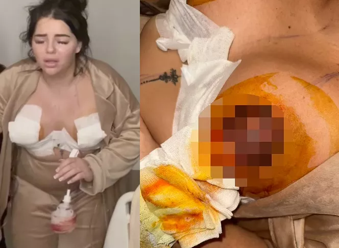 22-year-old woman left with 'dying n!pples' after she flew to Turkey for breast uplift surgery that went 'severely wrong' (Photos)