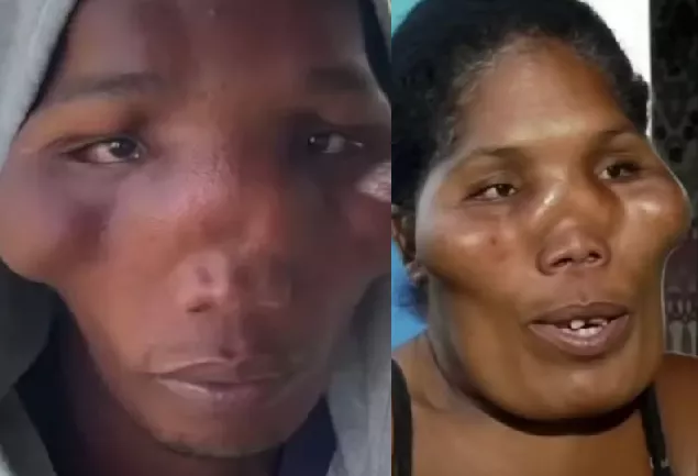 Family with mystery illness dubbed aliens after bizarre condition left them with swollen and disfigured faces