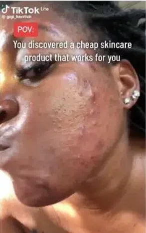 'It cost less than N1k' - Lady who battled severe acne shares skin routine that gave her incredible facial transformation