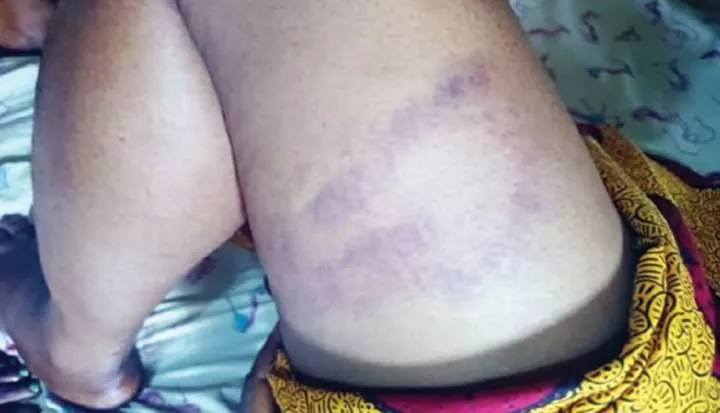 Nursing mother disfugured after she was allegedly brutalised by Special Anti Touting squad in Anambra