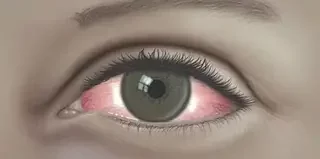 Season of red eyes