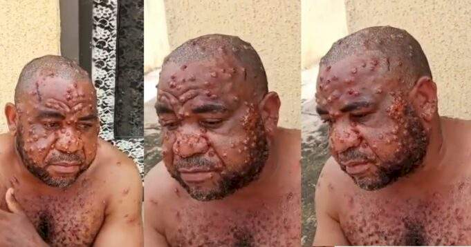 Nigerian man suffering from Monkey Pox narrates how he was misdiagnosed by multiple doctors as he talks about the ailment (video)