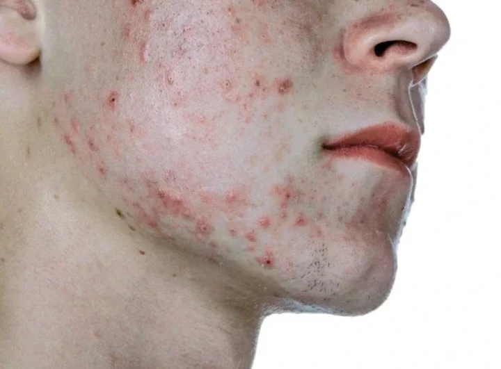 Here are seven things that can cause pimples, and you should stop doing them