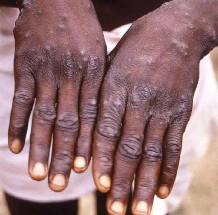 Ghana confirms first case of monkeypox in 2024