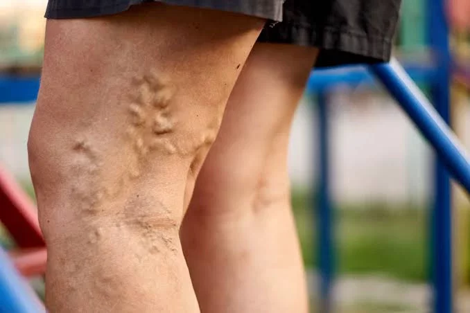 Steps You Can Take to Get Rid Of Swollen Veins On The Legs