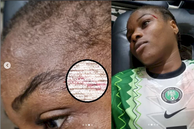 Super Falcons striker, Oparanozie Desire shows injury she sustained after head Collision (Photos)