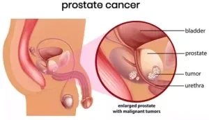 What Some Men Do On A Regular Basis That Can Cause Prostate Problems