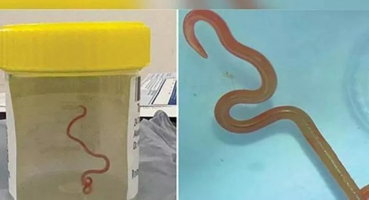 Eight-cm Ophidascaris robertsi roundworm, usually found in pythons (Credit: BOL News)