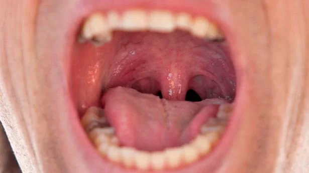 Dry mouth could be a 'red flag' symptom for five serious illnesses.