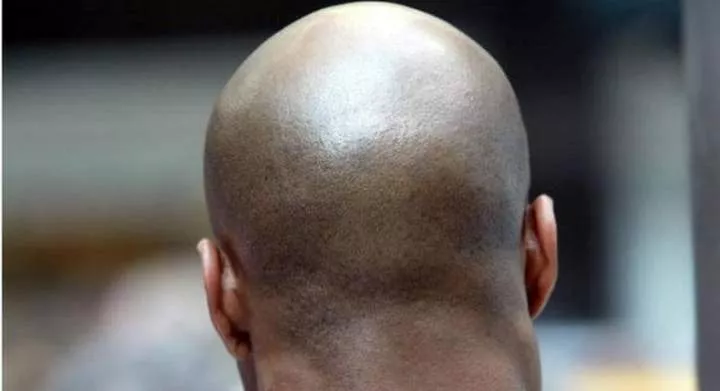 Aside from genetics, 12 other things that can cause baldness
