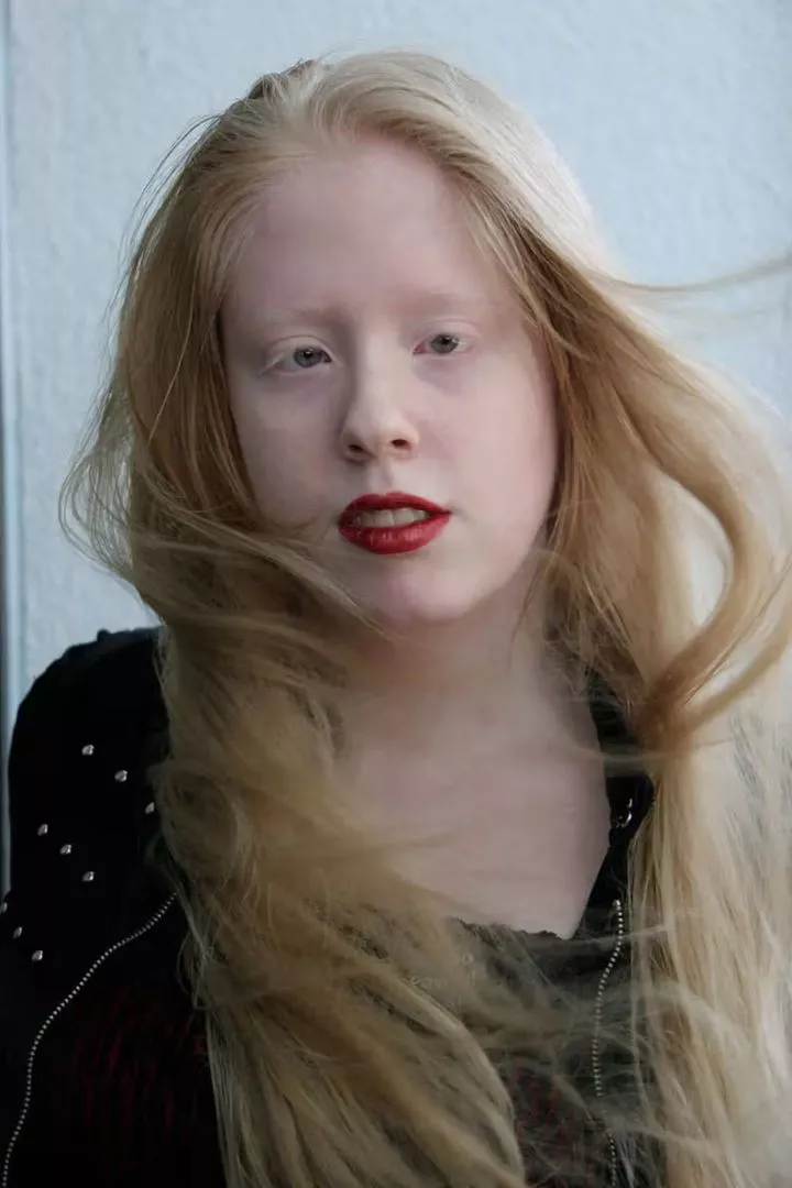 5 types of albinos and how they look (Photos)