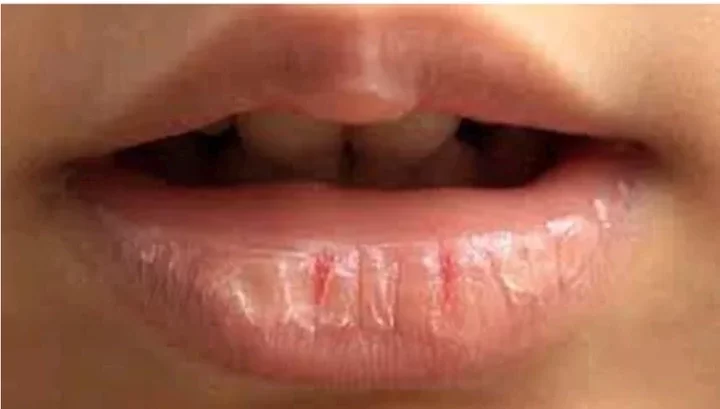 If You Have Dry and Cracked Lips, Here Is What It Means