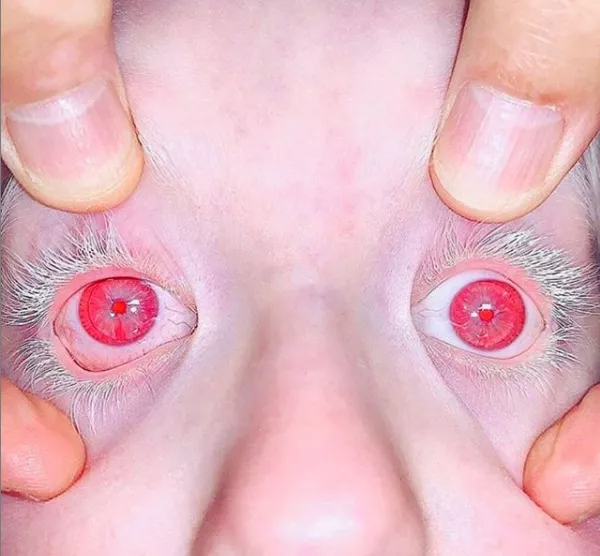 Crying blood and 5 other strange things that can happen to your eyes