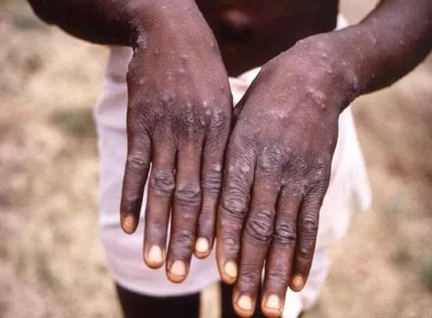 NCDC Reports Higher Mpox Infection Among Males In Nigeria