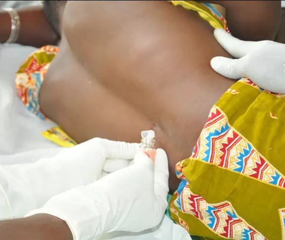 FG warns of Meningitis outbreak in Nigeria