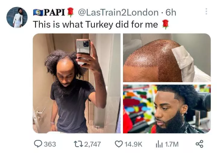 Bald man shows off amazing transformation after getting hair transplant surgery