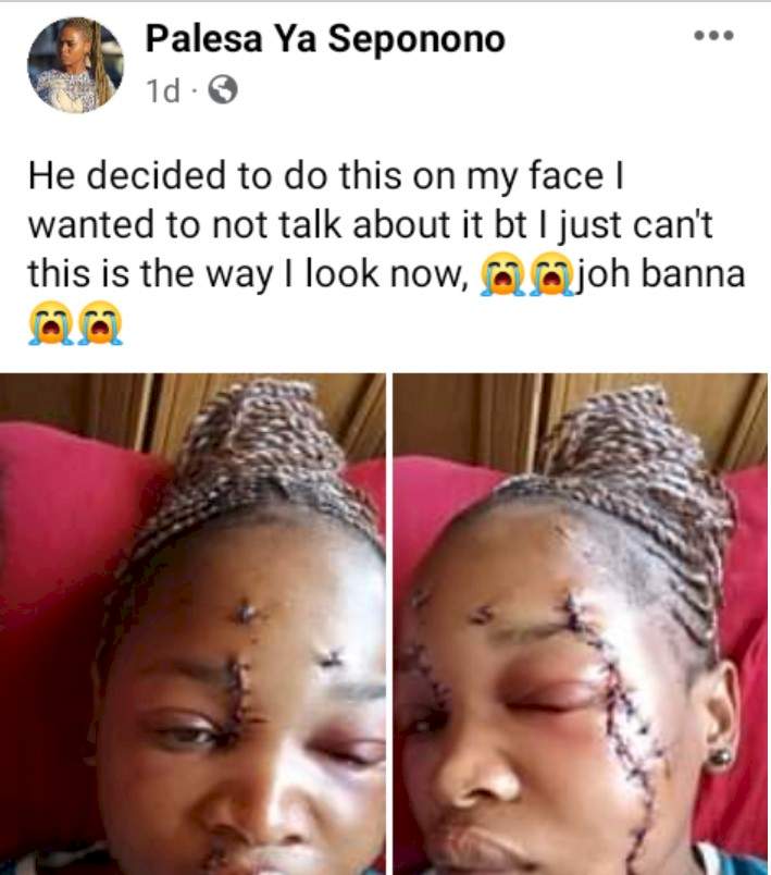 'This is the way I look now' - South African lady shows disfigured face after her baby daddy attacked her with bottle
