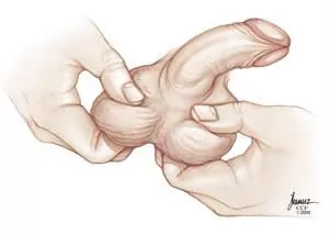 A hand grips a scrotum, which contains a partially visible testicle.