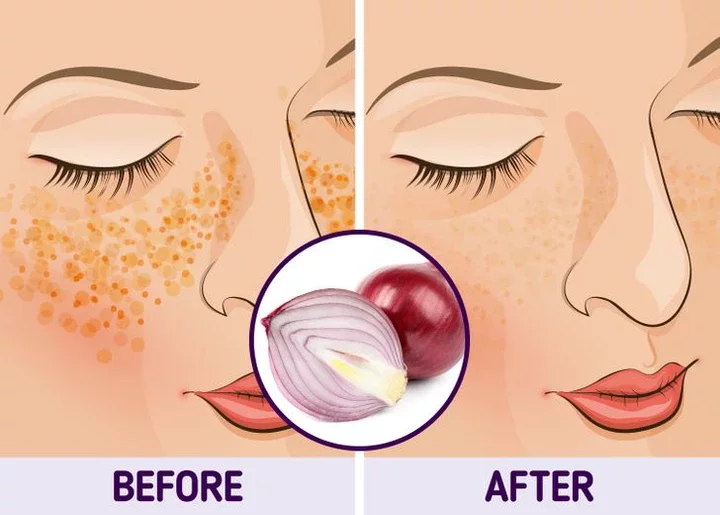 Reasons Why Men and Women Should Rub Onions on Their Face