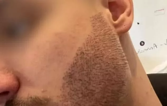 French student k!lls himself after getting a botched beard transplant 