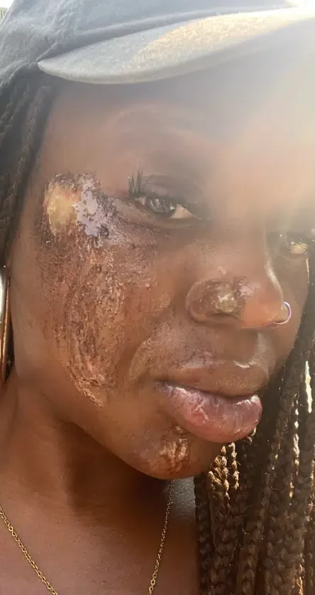 'This is unbelievable' - Nigerian lady stuns many as she shares photo of her face after surviving a fatal car accident