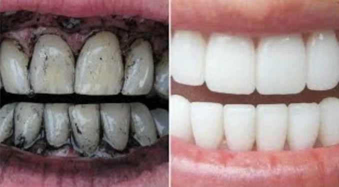 10 natural methods to whiten your teeth at home