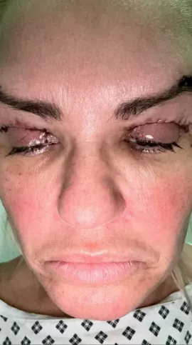 Kerry Katona struggles to open eye after painful eye-lift surgery