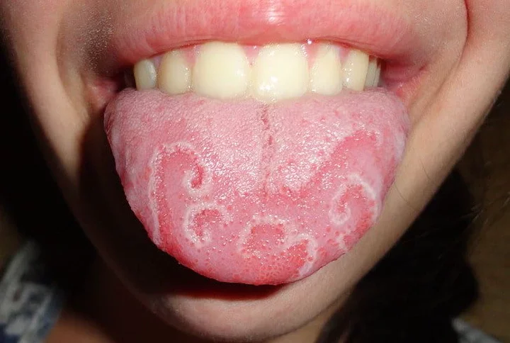 White Tongue: Symptoms, Causes, and Home Remedies for Treatment