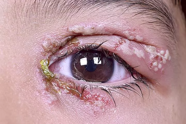 Crying blood and 5 other strange things that can happen to your eyes