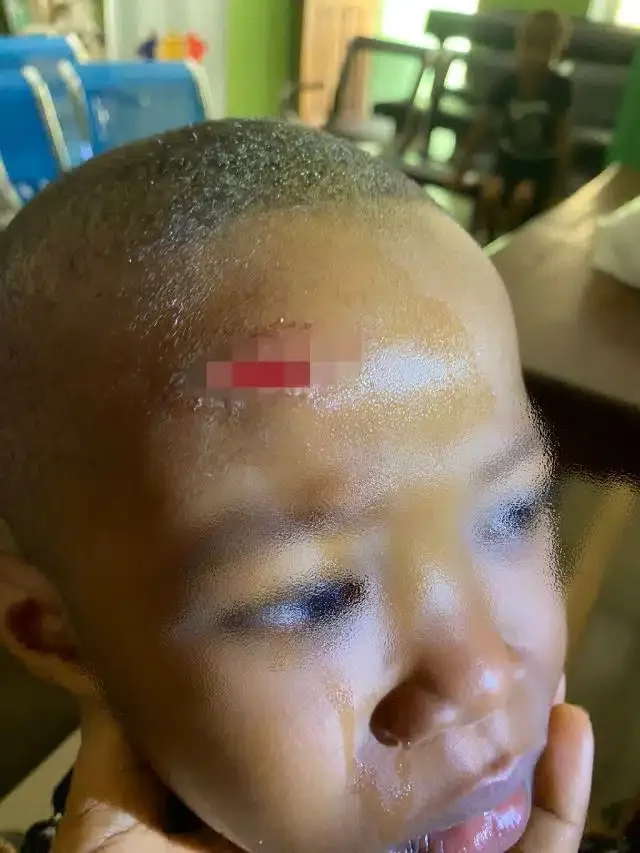 Mother cries out over scar on son inflicted by classmate at school