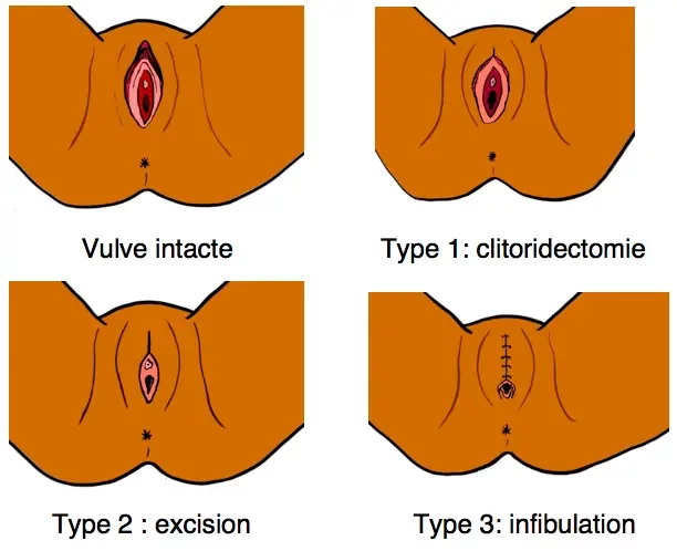 The horrors of female genital mutilation and infibulation