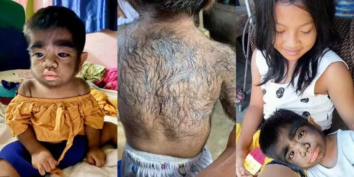 Mother fears son's 'werewolf syndrome' linked to eating cat during pregnancy