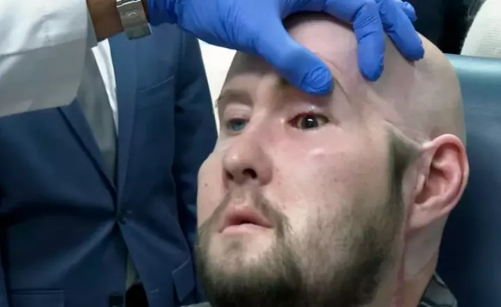 Surgeons perform first whole eye transplant