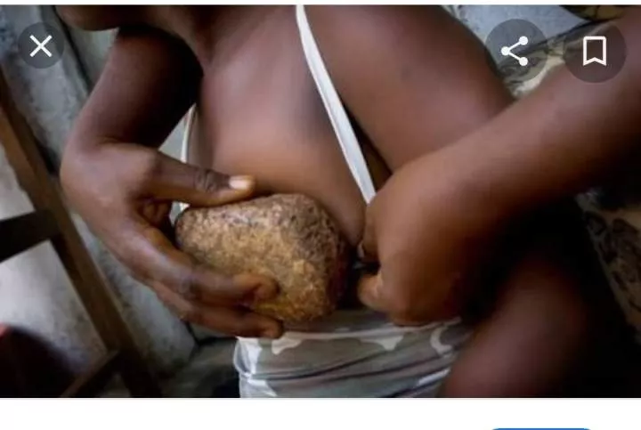 Breast ironing: culture that defies modernism