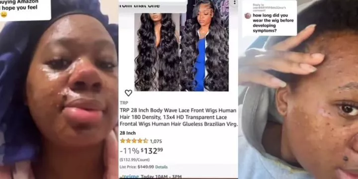 Woman suffers severe skin reaction from $132 wig bought on Amazon