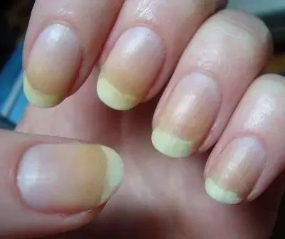 Here's what your fingernails reveal about the state of your health