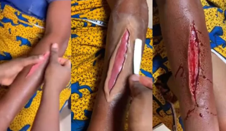 How Beggars Are Creating Fake Injuries