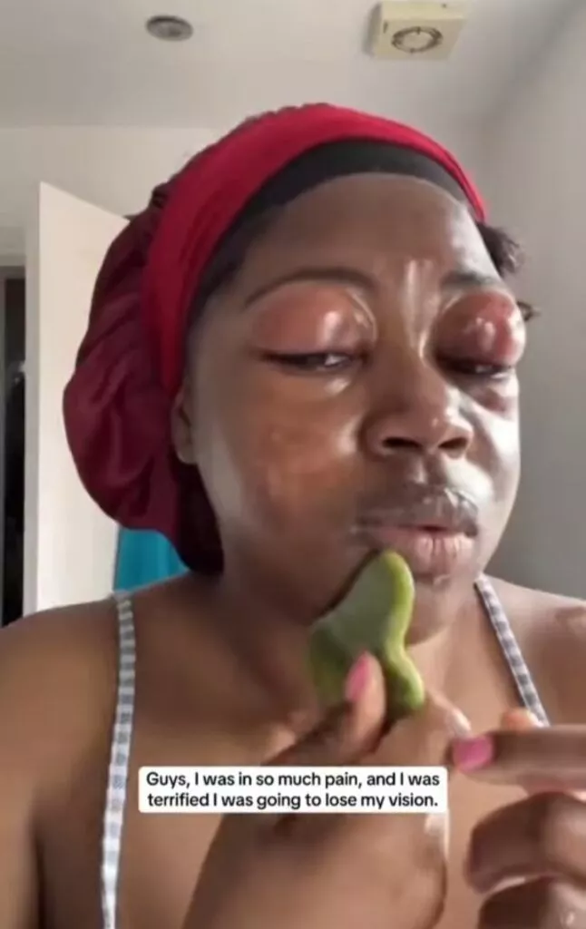 Lady shares how her eyelids began to swell after using eyelash extensions