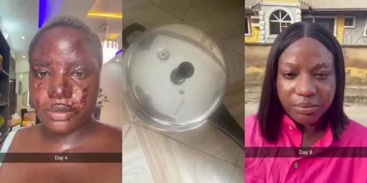 Beautiful lady narrates terrifying experience where a pressure pot nearly took her sight