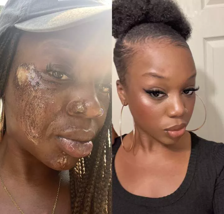 Nigerian lady shares photo of her healed face after surviving car accident