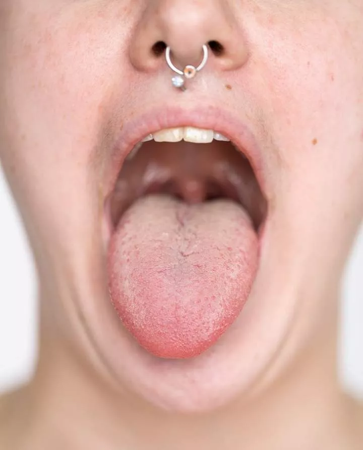 White Tongue: Symptoms, Causes, and Home Remedies for Treatment