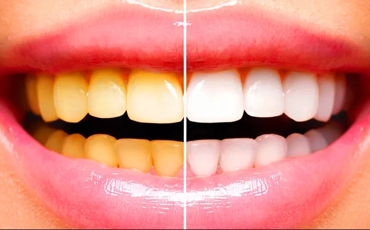 Natural Ways You Can Remove Yellow Stains From Your Teeth